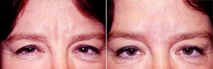 Restylane Patient, Before and After Photo