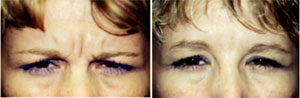 Botox Patient, Before and After Photo