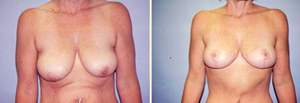 Breast Lift Patient, Before and After Photo
