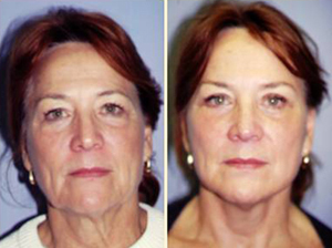 Cheek lift patient, Before and After