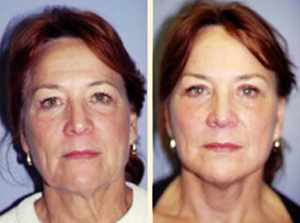 Face lift Patient, Before and After Photo