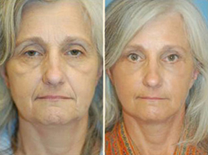 Facelift Patient, Before and After Photo