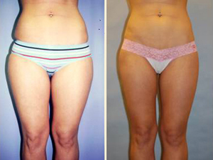 Liposuction Patient, Before and After Photo