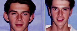 Otoplasty Patient, Before and After Photo