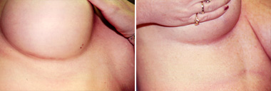 Pratt Seattle Secret Scar Technique