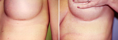 Pratt Seattle Secret Scar Technique