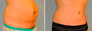 Abdominoplasty Before and After Patient Photo